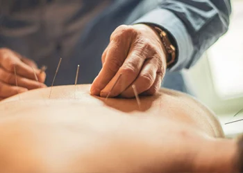 acupuncture